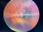 Zobacz Guzy tarczy nerwu wzrokowego. Badanie dna oka