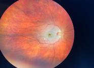 Zobacz Świeży zator tętnicy siatkówki. Badanie dna oka