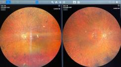 Zobacz Obraz siatkówki w zwyrodnieniu barwnikowym, widoczne charakterystyczne tzw. komórki kostne. Badanie dna oka