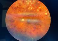Zobacz Zakrzep żyły środkowej siatkówki przebyty z proliferacjami nadtarczowymi. Badanie dna oka