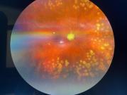 Zobacz Zanik nerwu wzrokowego w wyniku zatoru tętnicy siatkówki, stan po laserokagulacji. Badanie dna oka